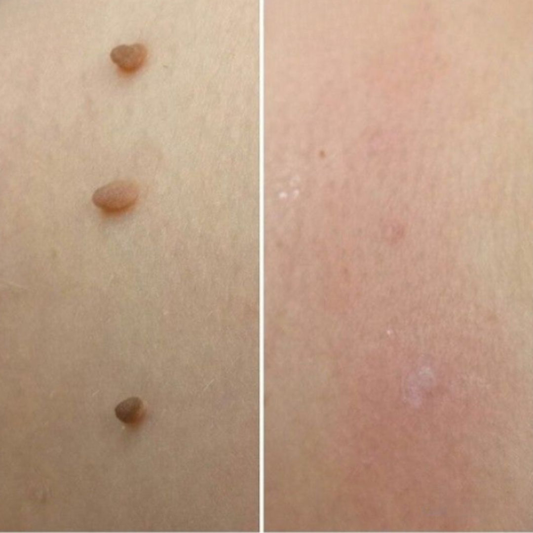 Huidverzorging Tool Skin Tag Remover Set Huidverzorging Apparaat